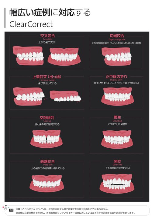 クリアコレクト矯正