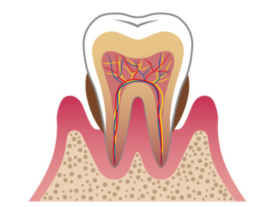 歯周病治療