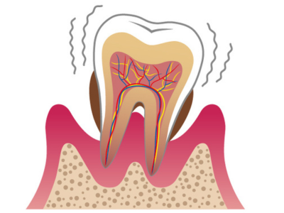 歯周病治療