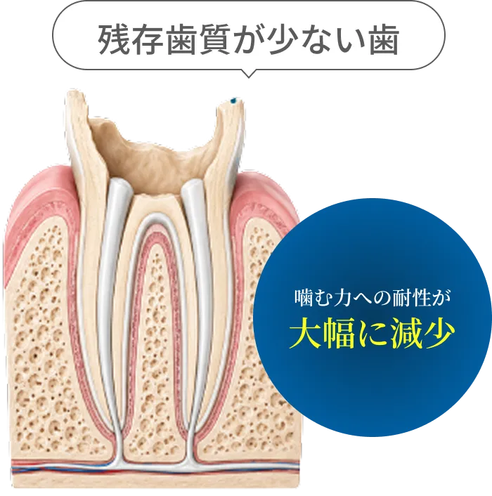 残存歯質が少ない歯は噛む力への耐性が大幅に低下することを示す図