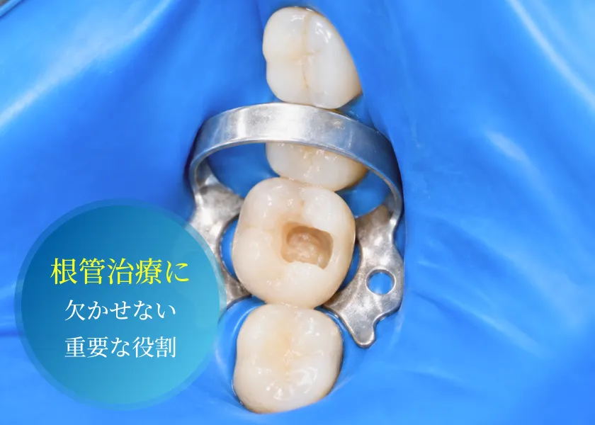 ラバーダム防湿による清潔な根管治療環境（画像内テキスト：根管治療に 欠かせない 重要な役割）