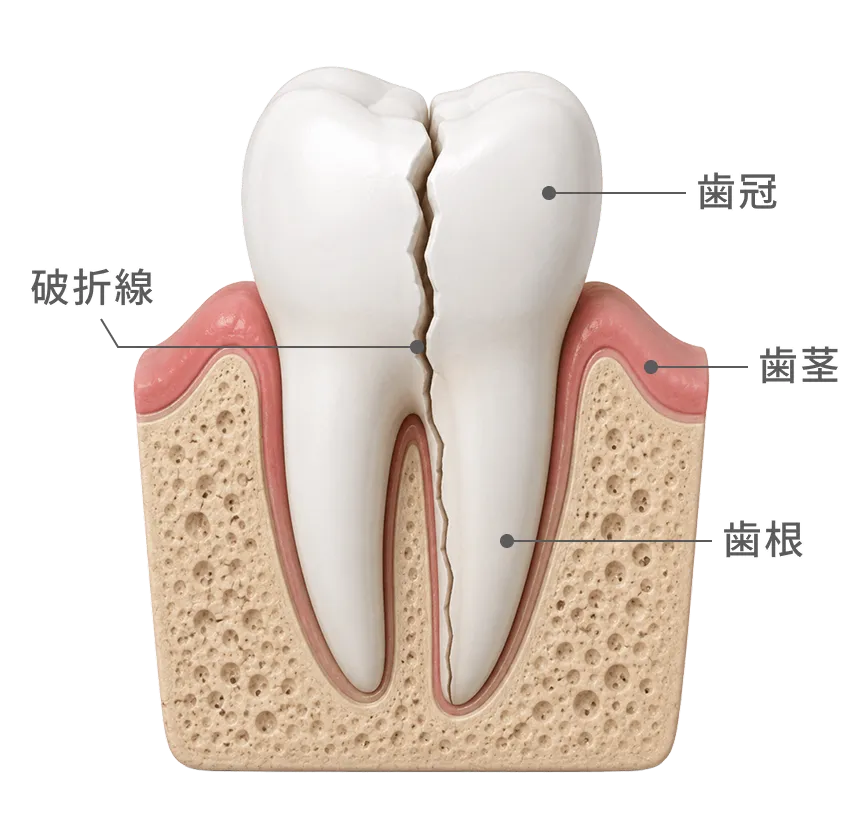 歯冠・歯茎・歯根と、歯根に生じた破折線の位置
