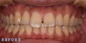 マウスピース型矯正「クリアコレクト」症例01（ビフォー）｜青山一丁目麻布歯科