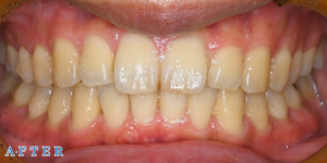 マウスピース型矯正「クリアコレクト」症例01（アフター）｜青山一丁目麻布歯科